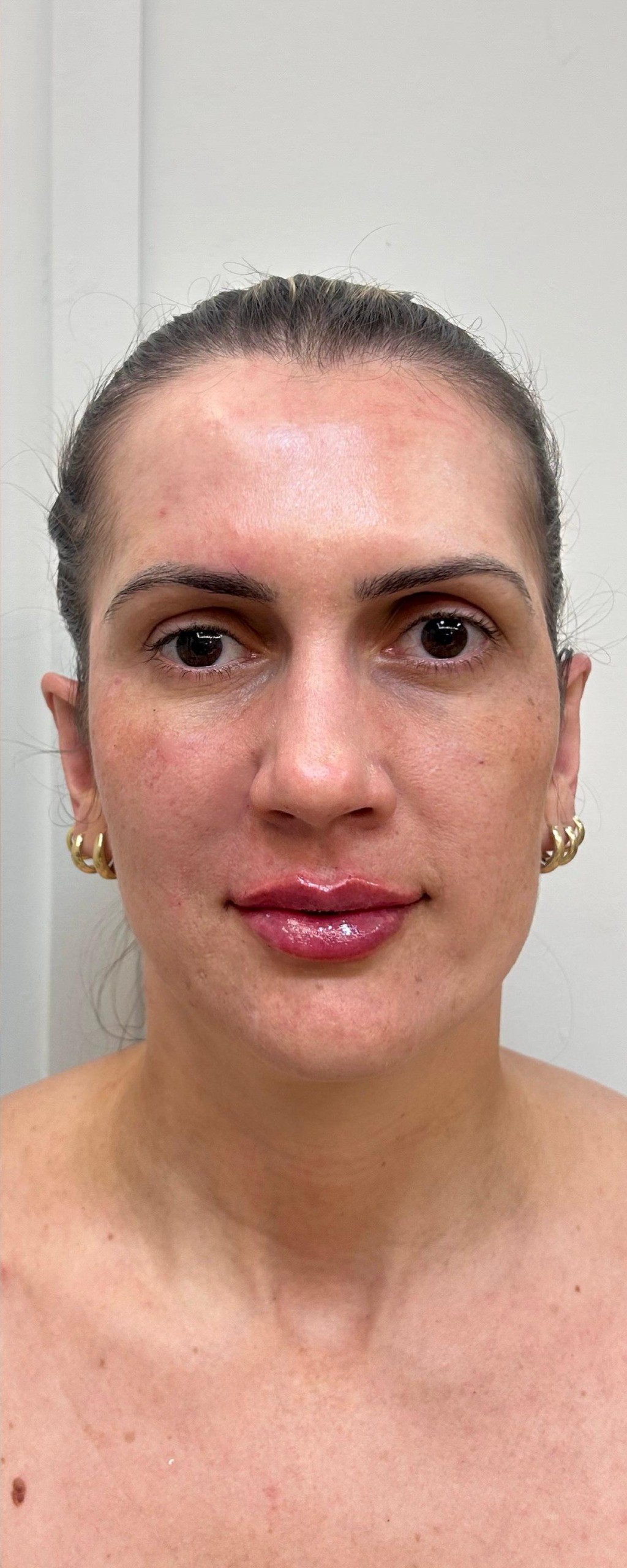 Full Face - depois, caso 2