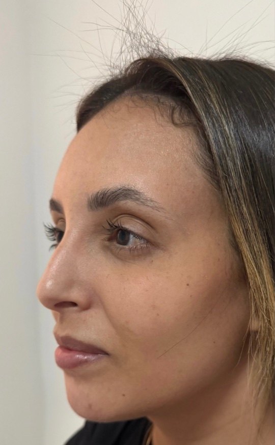 Full Face - antes, caso 4