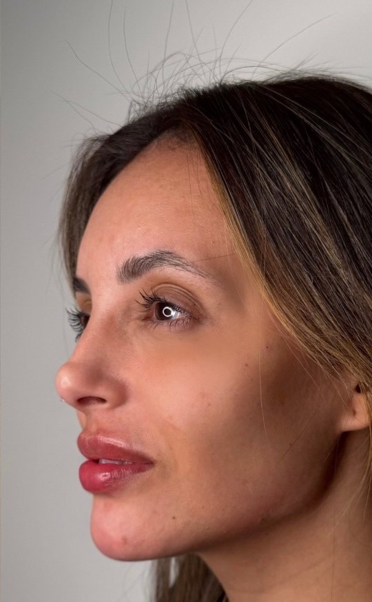 Full Face - depois, caso 4