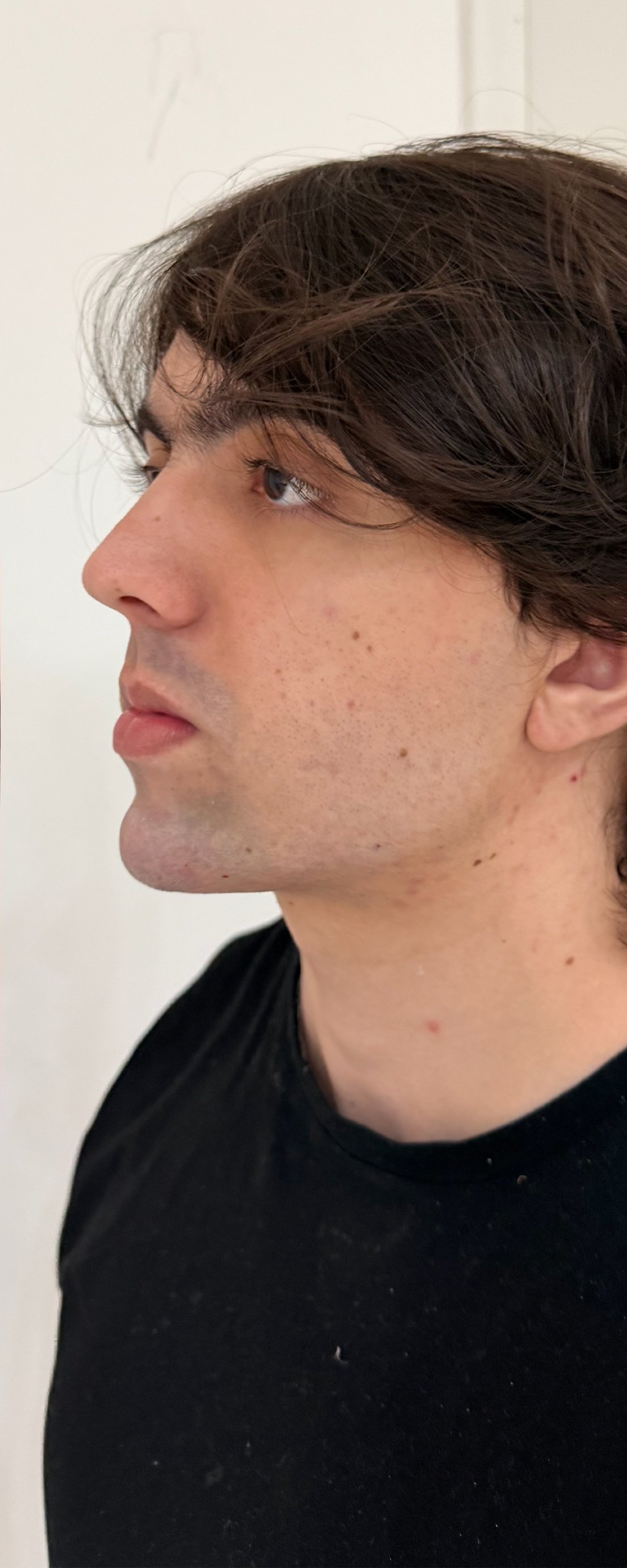 Full Face - depois, caso 5