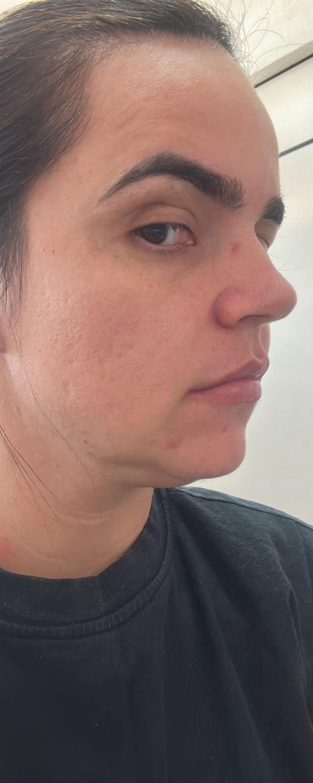 Full Face - antes, caso 6