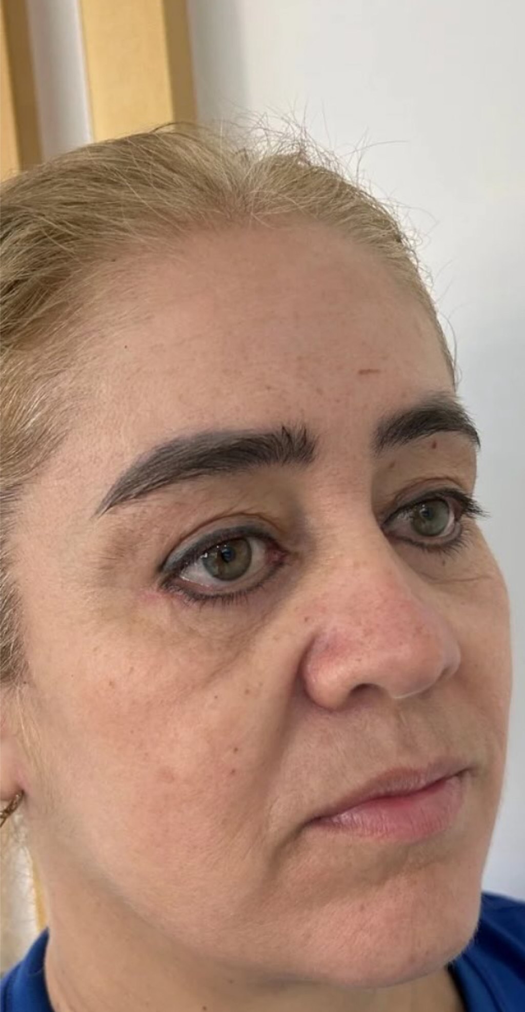 Full Face - antes, caso 8