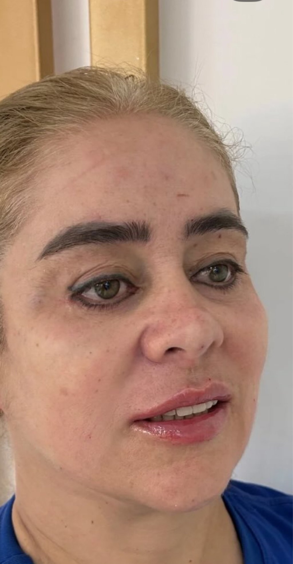 Full Face - depois, caso 8