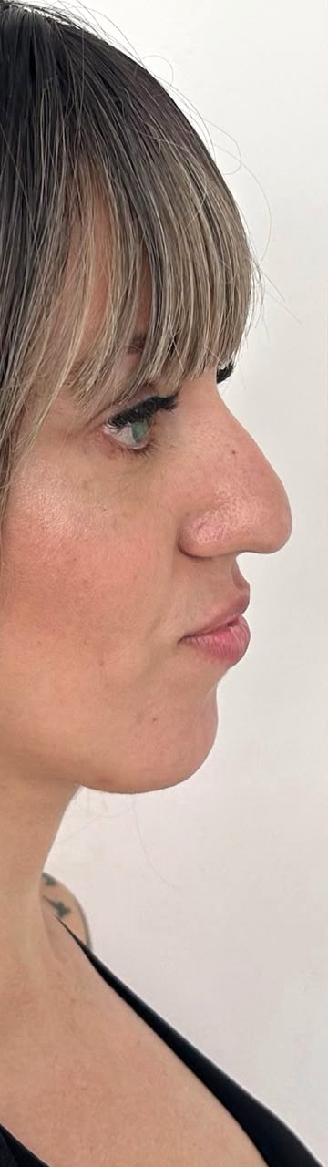 Perfiloplastia - antes