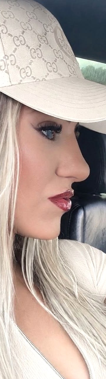 Perfiloplastia - depois