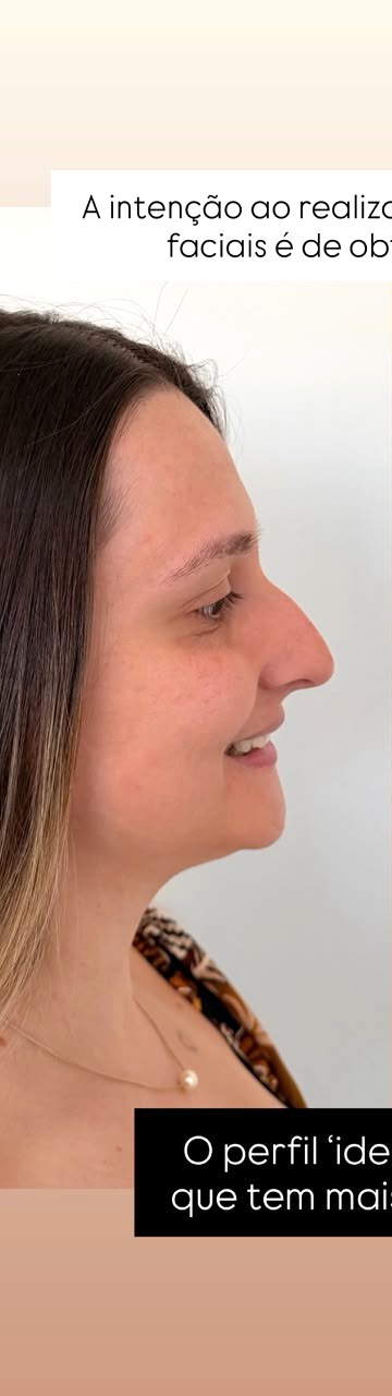Perfiloplastia - antes, caso 2