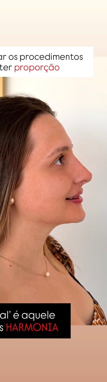 Perfiloplastia - depois, caso 2