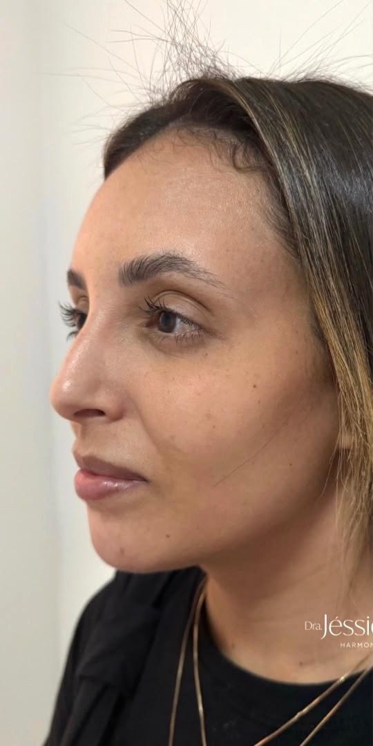 Perfiloplastia - antes, caso 3