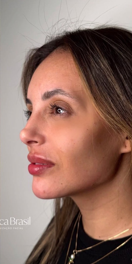 Perfiloplastia - depois, caso 3