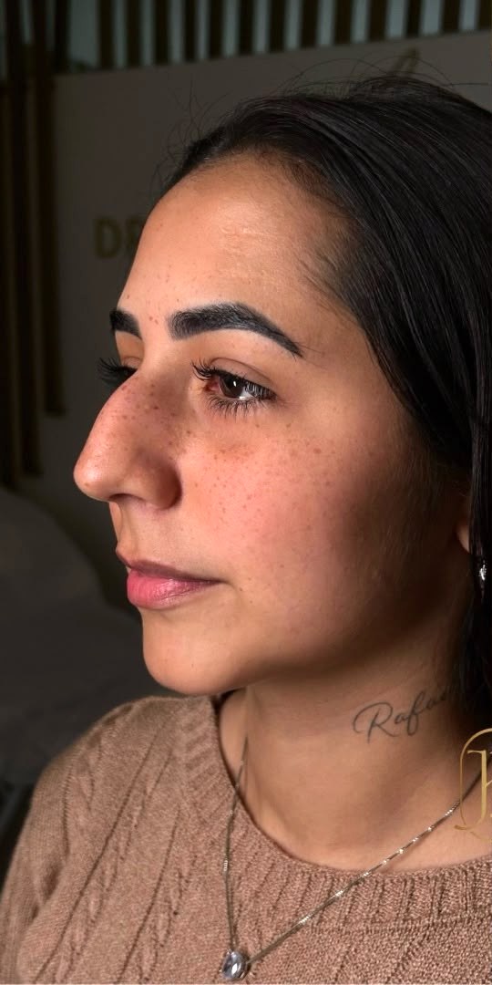 Perfiloplastia - antes, caso 4