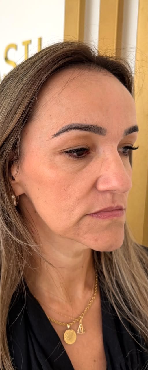 Perfiloplastia - antes, caso 5