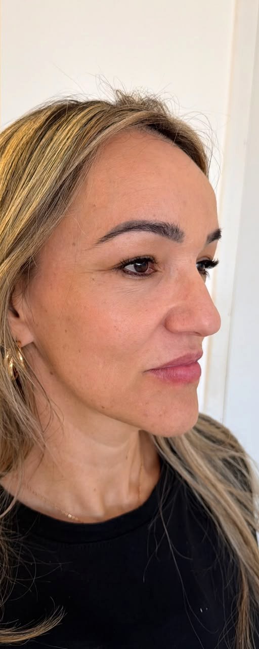 Perfiloplastia - depois, caso 5