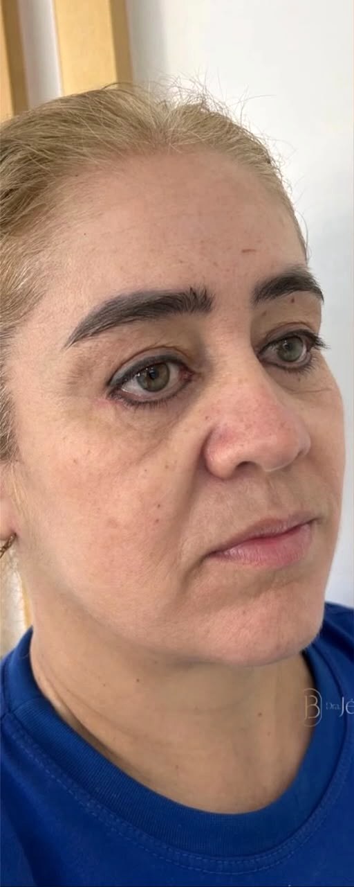 Perfiloplastia - antes, caso 6