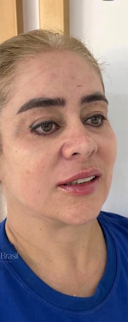 Perfiloplastia - depois, caso 6