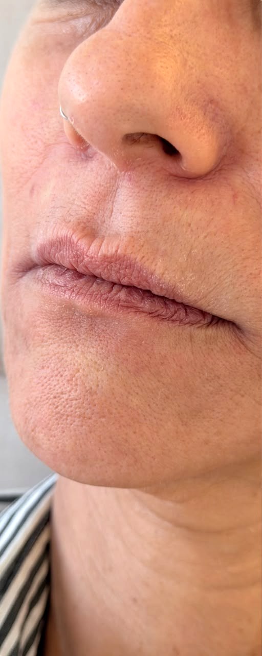 Preenchimento Labial - antes