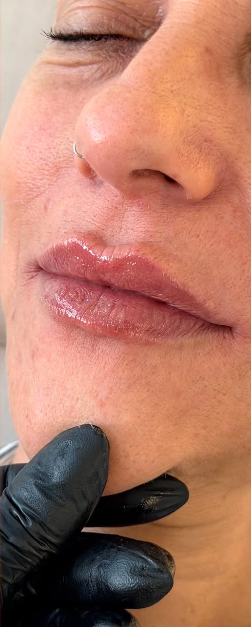 Preenchimento Labial - depois