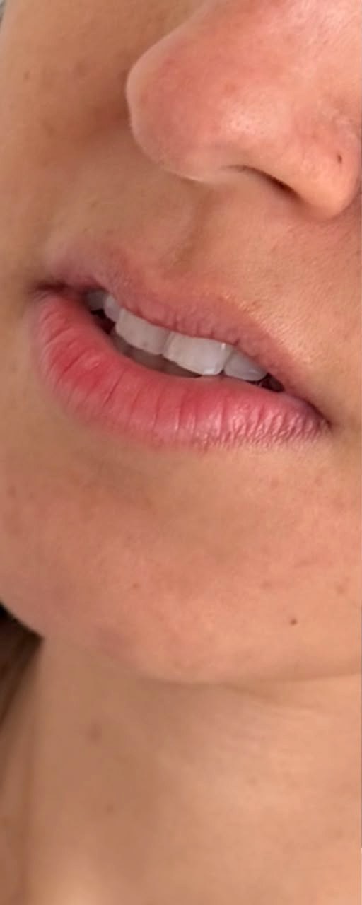 Preenchimento Labial - antes, caso 2
