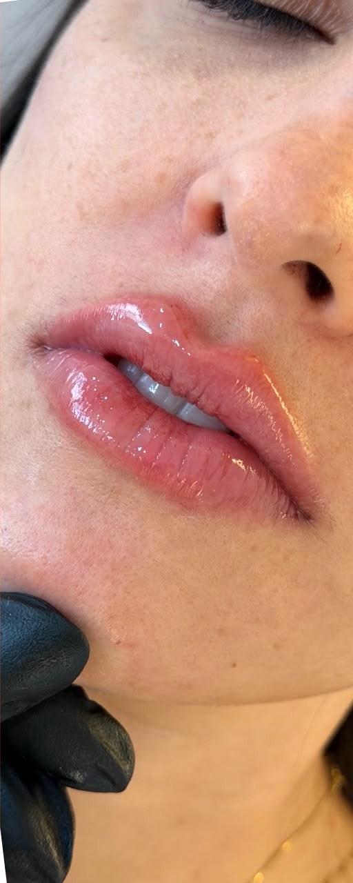 Preenchimento Labial - depois, caso 2