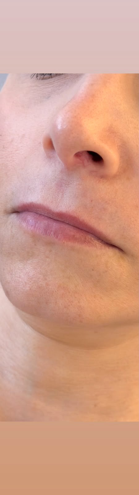 Preenchimento Labial - antes, caso 3