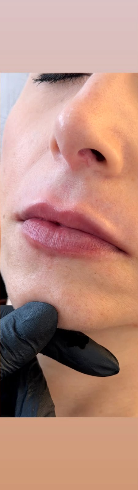 Preenchimento Labial - depois, caso 3