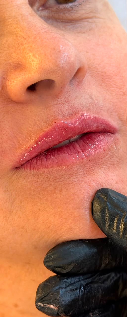 Preenchimento Labial - antes, caso 4