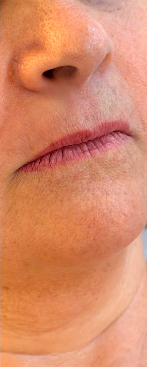 Preenchimento Labial - depois, caso 4