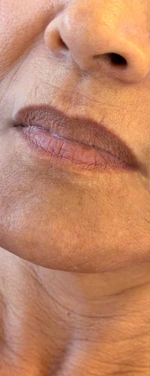 Preenchimento Labial - antes, caso 5