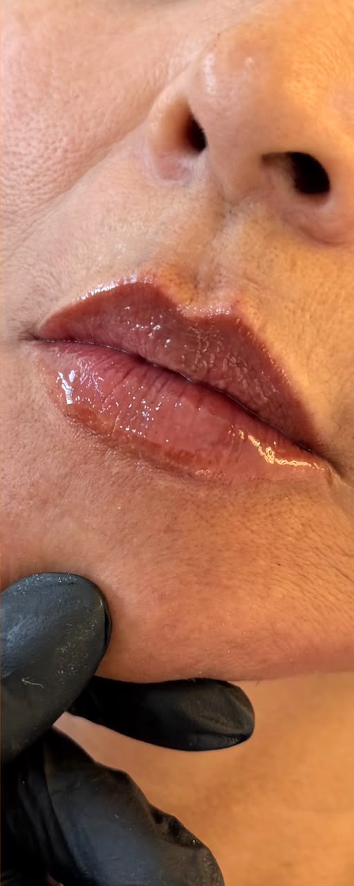 Preenchimento Labial - depois, caso 5