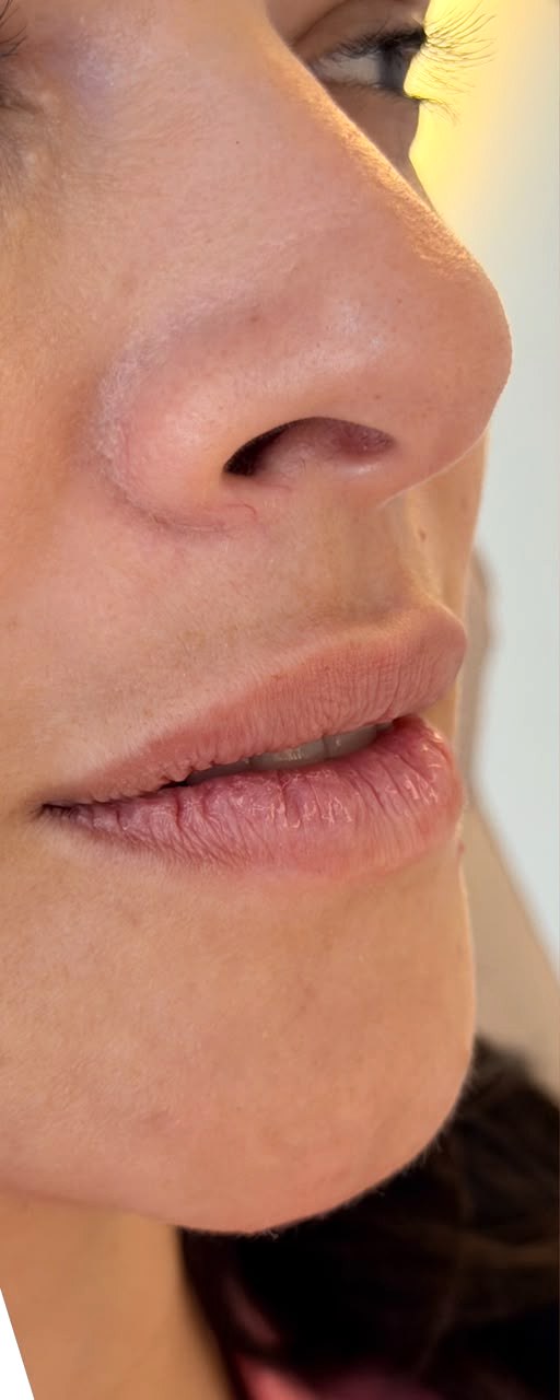 Preenchimento Labial - antes, caso 6