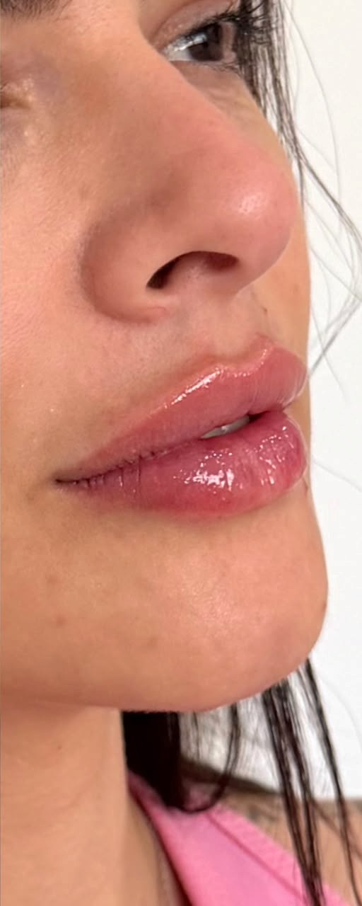 Preenchimento Labial - depois, caso 6