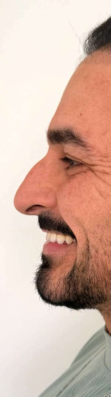 Rinomodelação - antes, caso 4