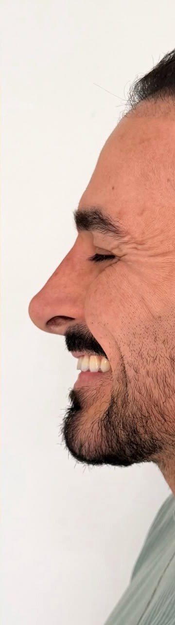 Rinomodelação - depois, caso 4